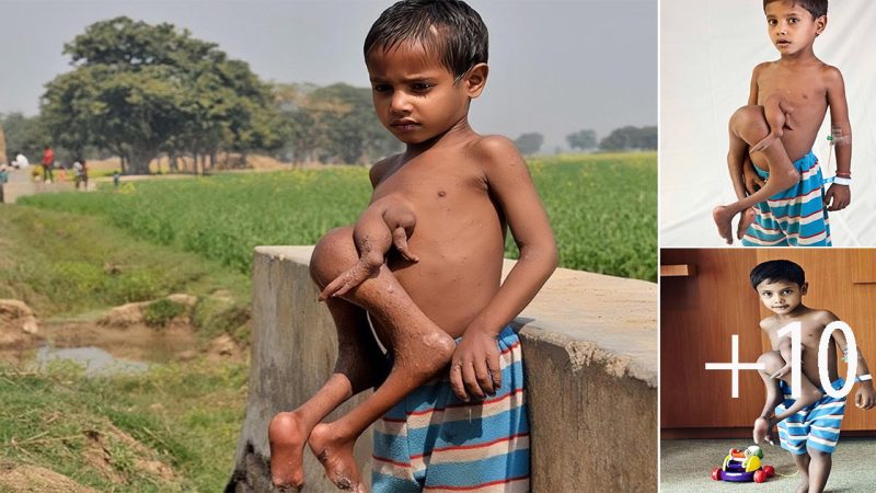 Beyond the Extraordinary: A Glimpse into the Daily Life of a Boy with Four Arms and Four Legs