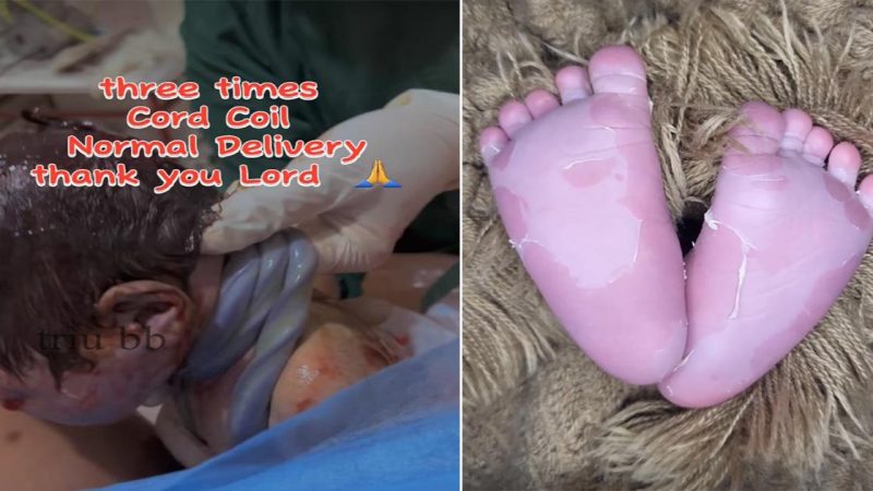 The baby was born by natural method, the umbilical cord was wrapped 3 times and the birth was successful beyond expectations with the help of 2 Midwives Jen Amante and Midwife Jacky Garces