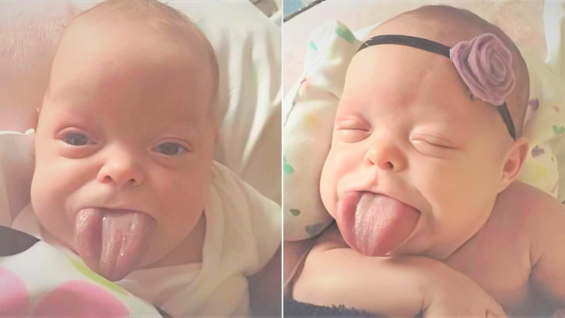 A baby born with an exceptionally large tongue can now finally smile.