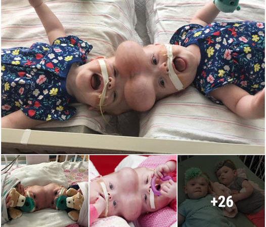 Conjoined Twins Successfully Separated in Remarkable Surgery