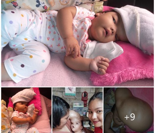 An Heartrending Tale: 11-Month-Old Afflicted by Enormous Cone-Shaped Growth on Their Head