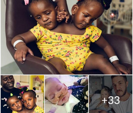 The Heartfelt Journey of Separated Conjoined Twins