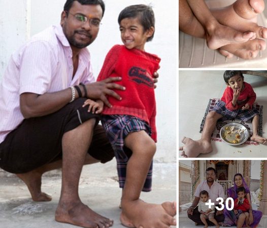 Unprecedented Resilience: The Inspiring Journey of a Young Boy with a Remarkably Heavy Foot