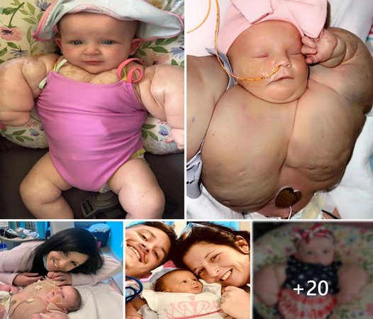 A Miraculous Journey of Courage: Baby Armai’s Battle with Lymphangioma